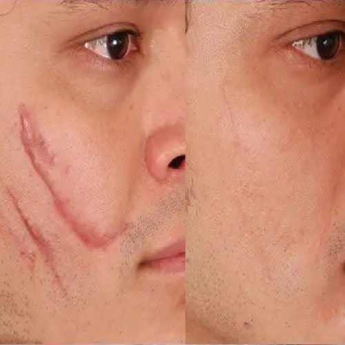 SILICONE SCAR