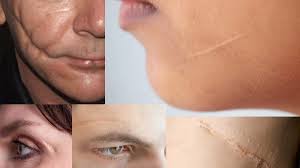 Silicone Scar Patch: The Ultimate Scar Removal Patch for Smooth, Healthy Skin